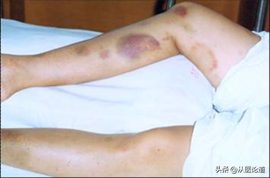 皮肤出现紫癜瘀点瘀斑,血小板减少性紫癜瘀斑
