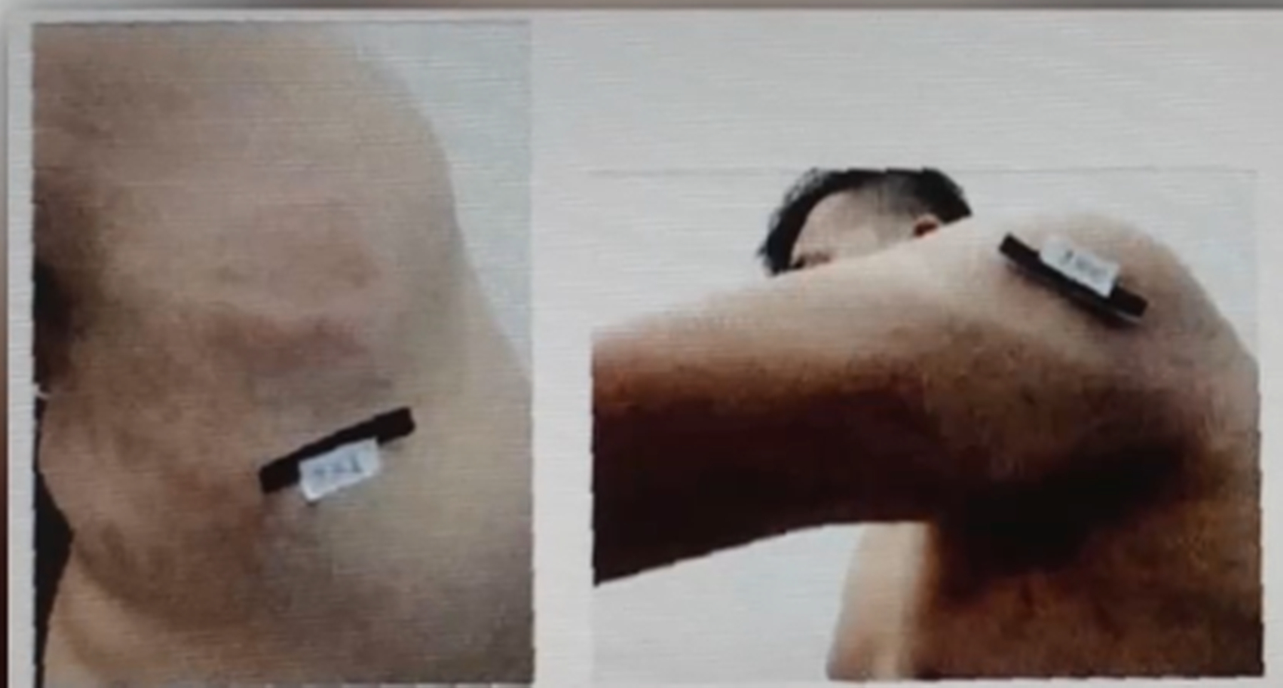 打架把别人鼻梁打断了判几年,打架鼻梁打断判刑几年