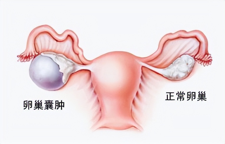 女性身体肥胖对卵巢囊肿有影响吗,老年女性突然查出卵巢囊肿严重吗