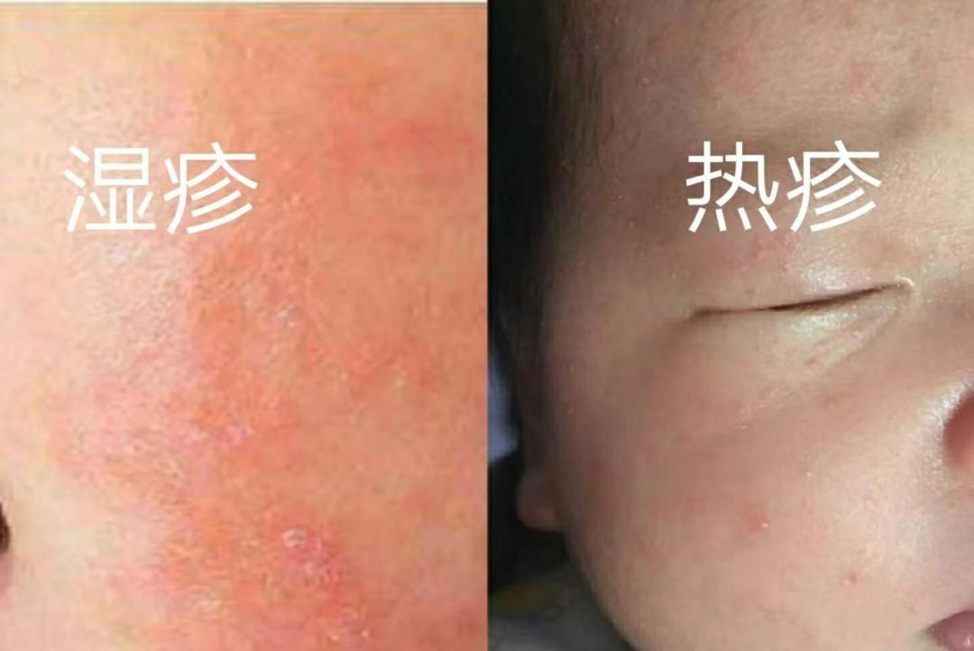 新生儿四种疹子,新生儿四种表现