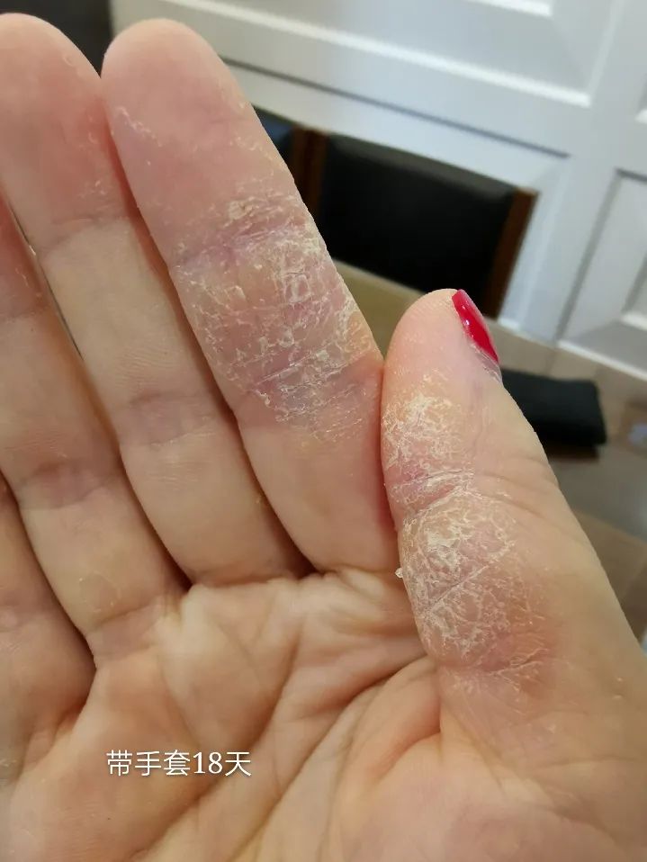 只需2步搞定宝宝湿疹,0-1岁祛湿疹的药