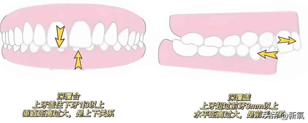 牙齿正畸和骨骼正畸的区别,牙齿正畸和眼轴增长有关系吗