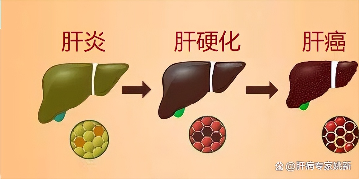 治疗肝硬化肝腹水的中医排行,肝有腹水中医怎么治疗
