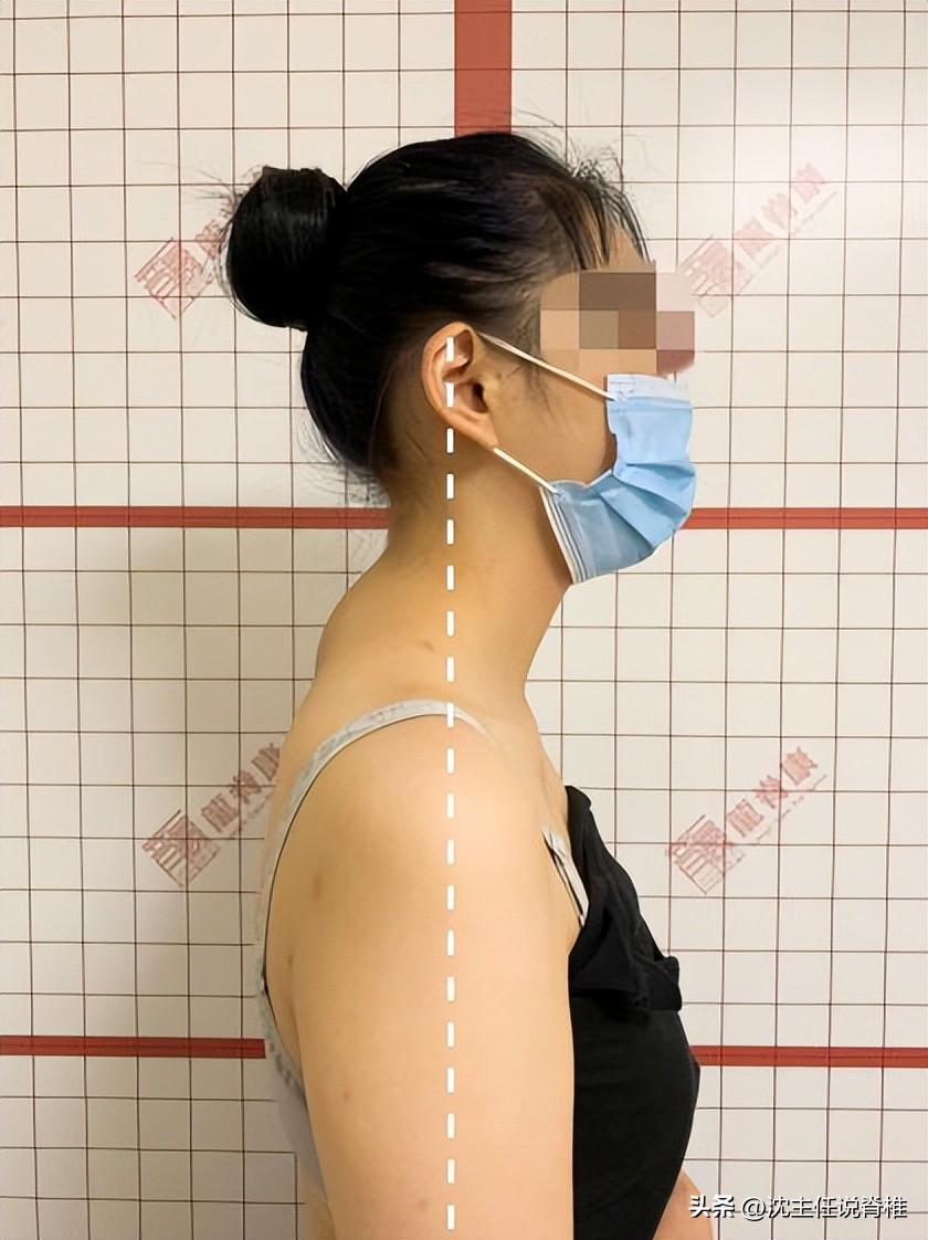 脖子后面与肩膀连接处的富贵包,脖子后面颈椎上的富贵包怎样消除