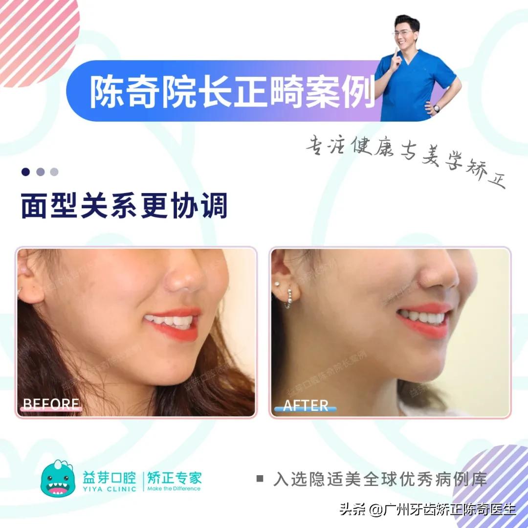 隐适美矫正和普通矫正的区别,隐适美矫正有几种版本