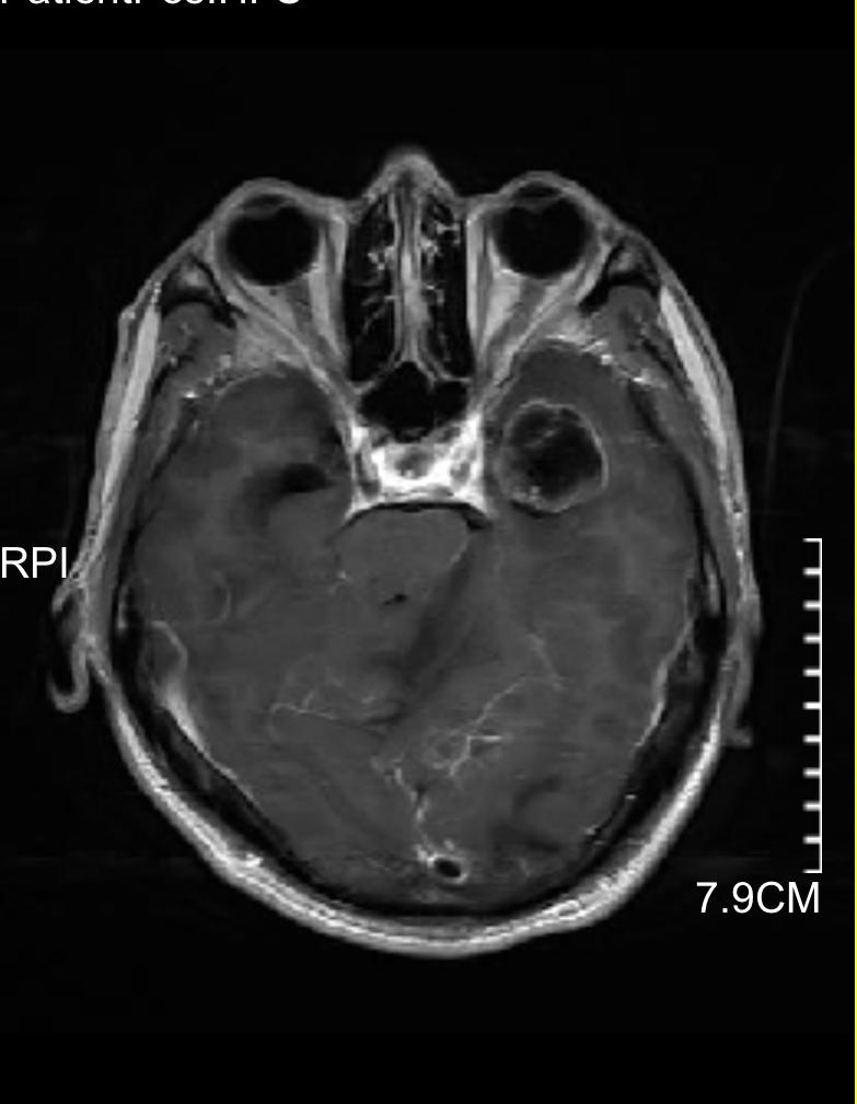 发现脑肿瘤怎么办,发现脑卒中前兆怎么办