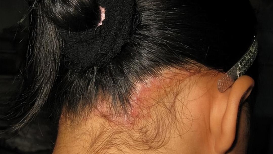 头皮上长红疙瘩脓包涂什么药膏,头皮上长红疙瘩脓包用什么药