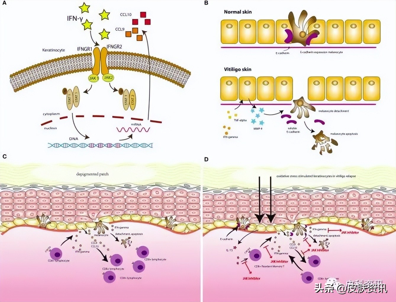 jak制剂治疗白癜风副作用,jak抑制剂治疗白癜风