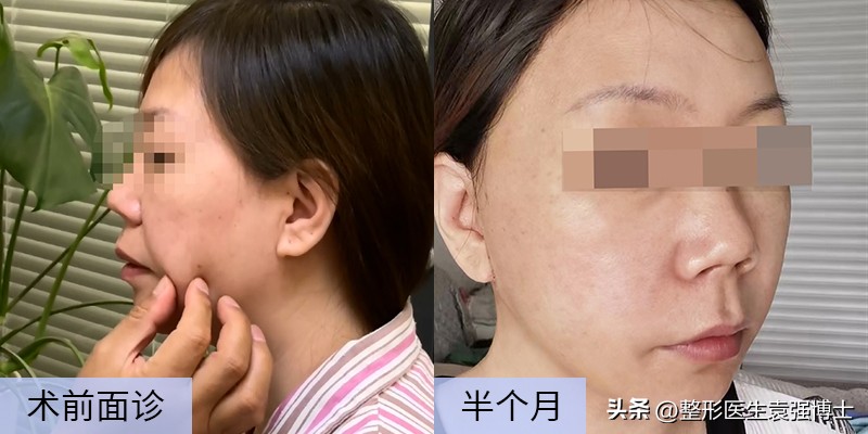 口角囊袋下垂怎么办,口角囊袋去掉会不会变松弛