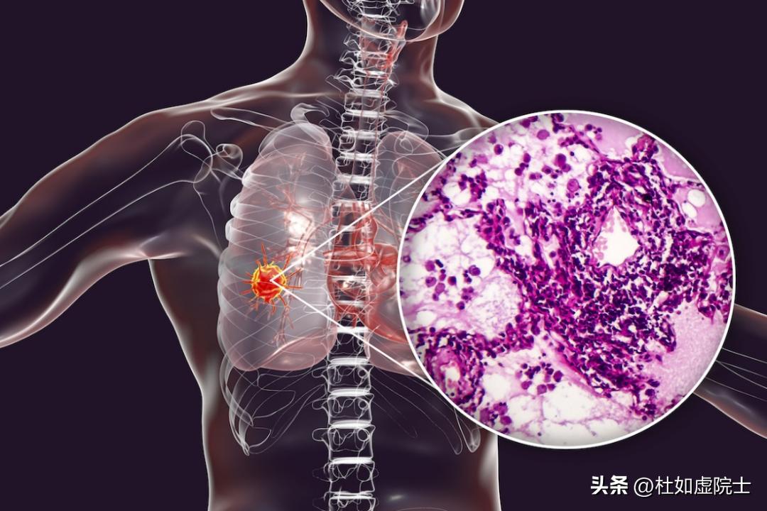 癌症免疫治疗和靶向药哪个好,癌症的免疫治疗与靶向治疗区别