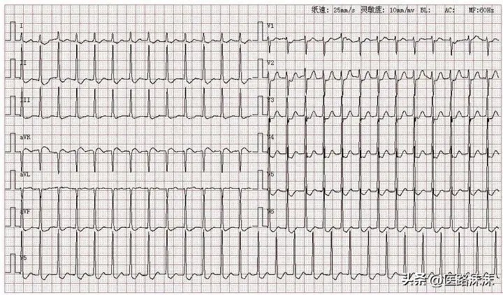 心动过速恢复方法,心动过速吃什么药