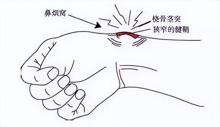 腱鞘炎小拇手指疼怎么治,由于劳累导致拇指腱鞘炎怎么办