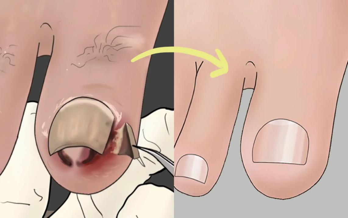 脚趾甲老往肉里钻，一碰还疼？教你小妙招，预防甲沟炎告别疼痛