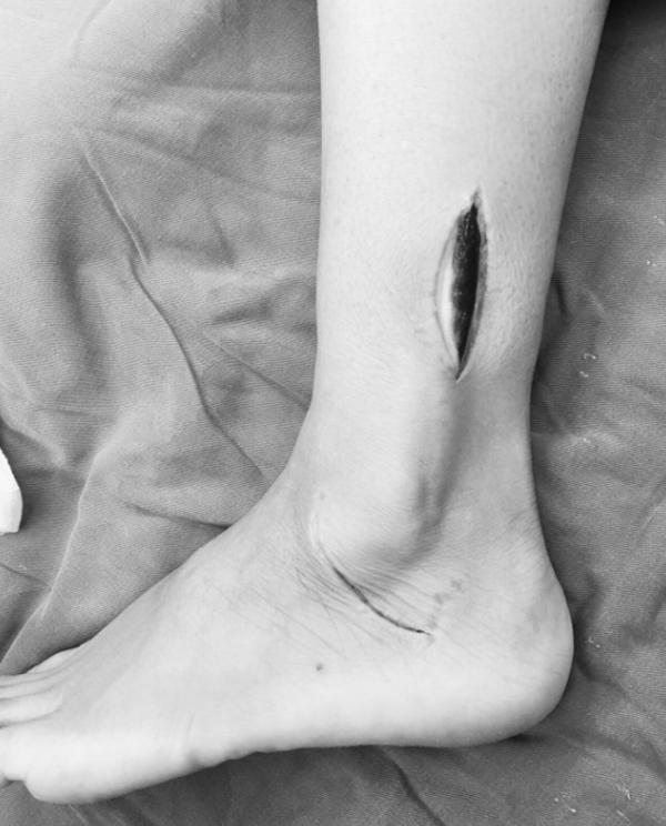 踝关节韧带损伤病历模板,踝关节外侧韧带损伤发病原因