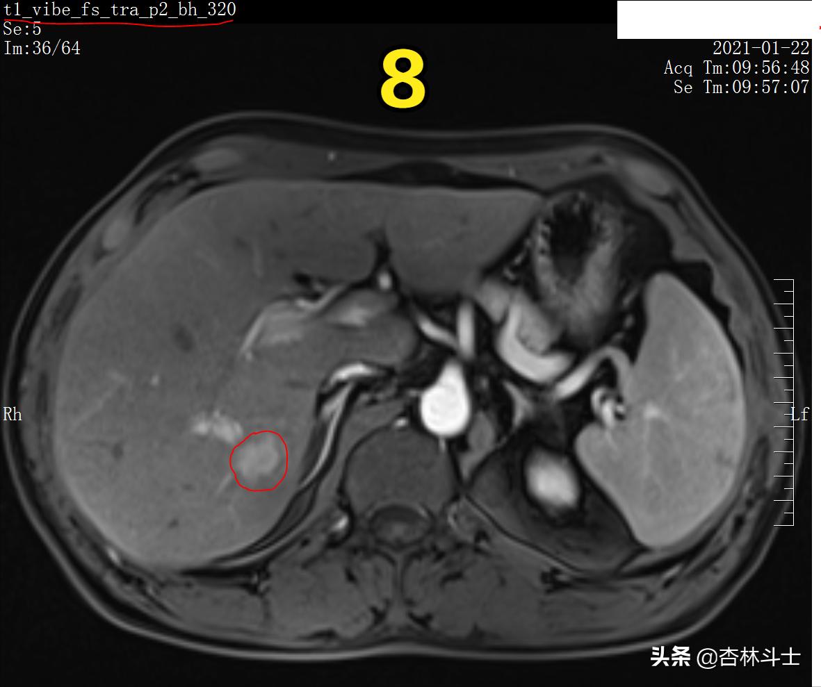 肝癌8公分肿瘤能活多久,肝癌细胞最大长多大