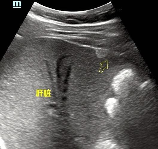 腹部彩超能查出什么病,腹部彩超能查出什么癌症吗