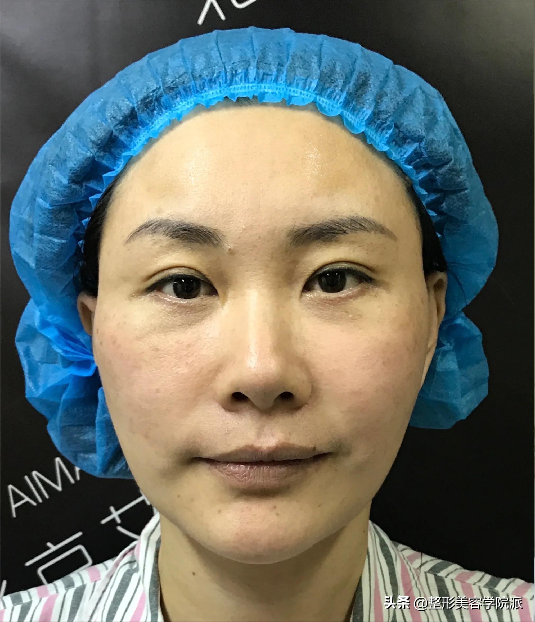 女29岁嘴角法令纹怎么办,脸部下垂法令纹做拉皮