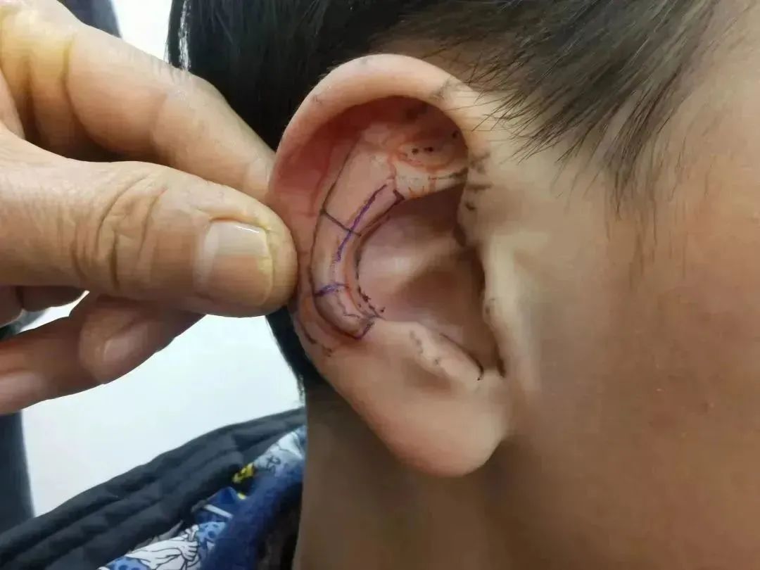 耳朵会说话|阳羡安仁坊耳穴疗法公益培训小记