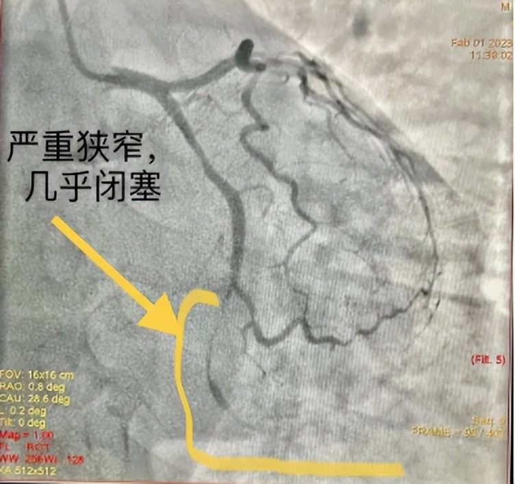 媒体聚焦丨一天一包烟，患上心绞痛！