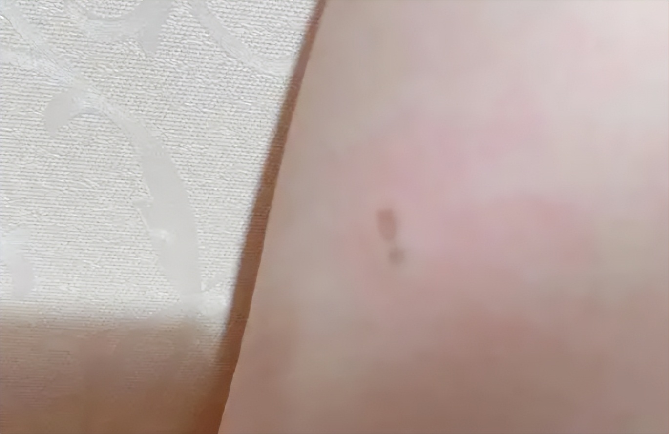 女孩iphone充电被电击面临截肢,iphone边充边玩被电击