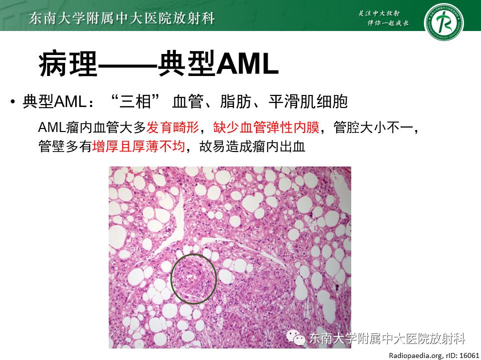 好文分享——《肾血管平滑肌脂肪瘤》