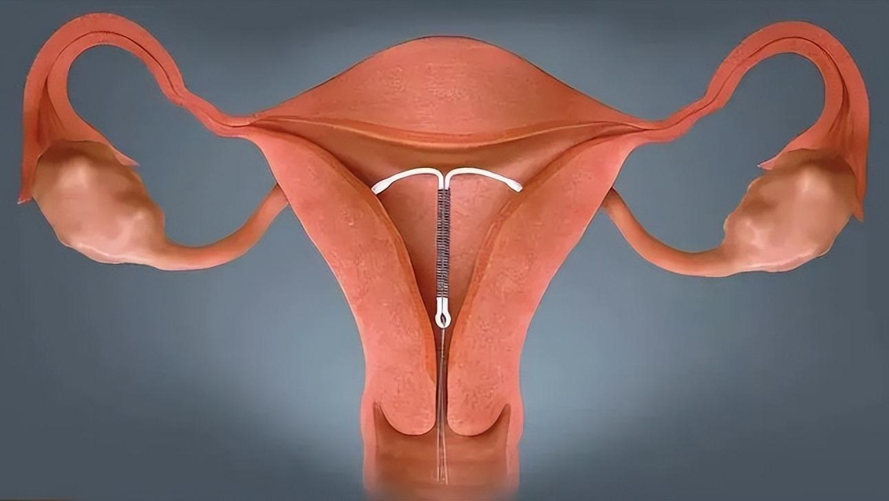 女性节育环不在原来的位置上了,女性节育环一定要从体内取出吗