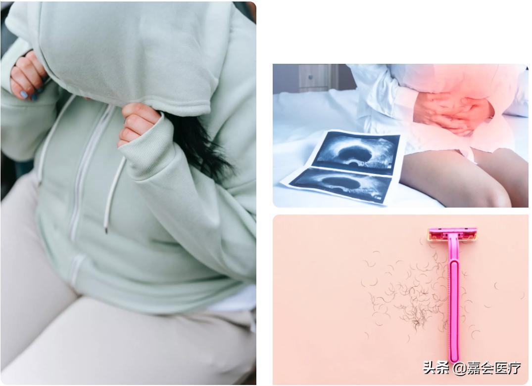 月经不调、*疮痤**、多毛...一定是「多囊」吗？