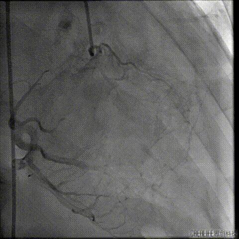 病例回顾与分享,腹膜后血肿介入治疗