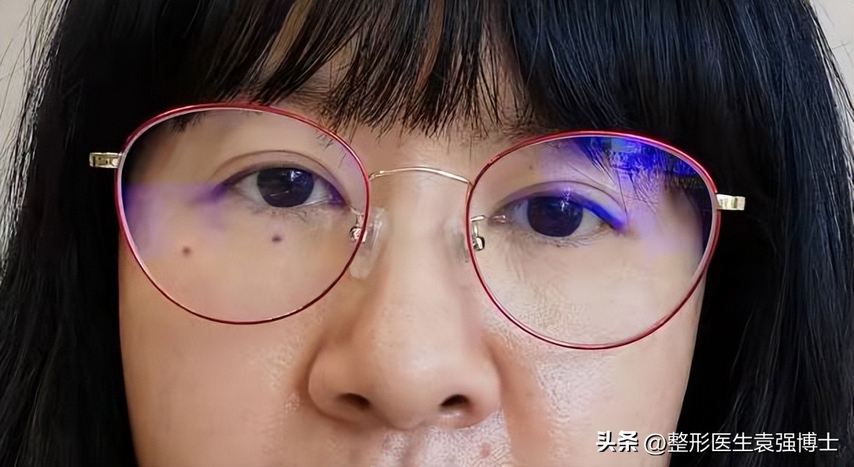 下眼皮下垂提眉能解决吗,眼皮下垂提眉和眼综合怎么选