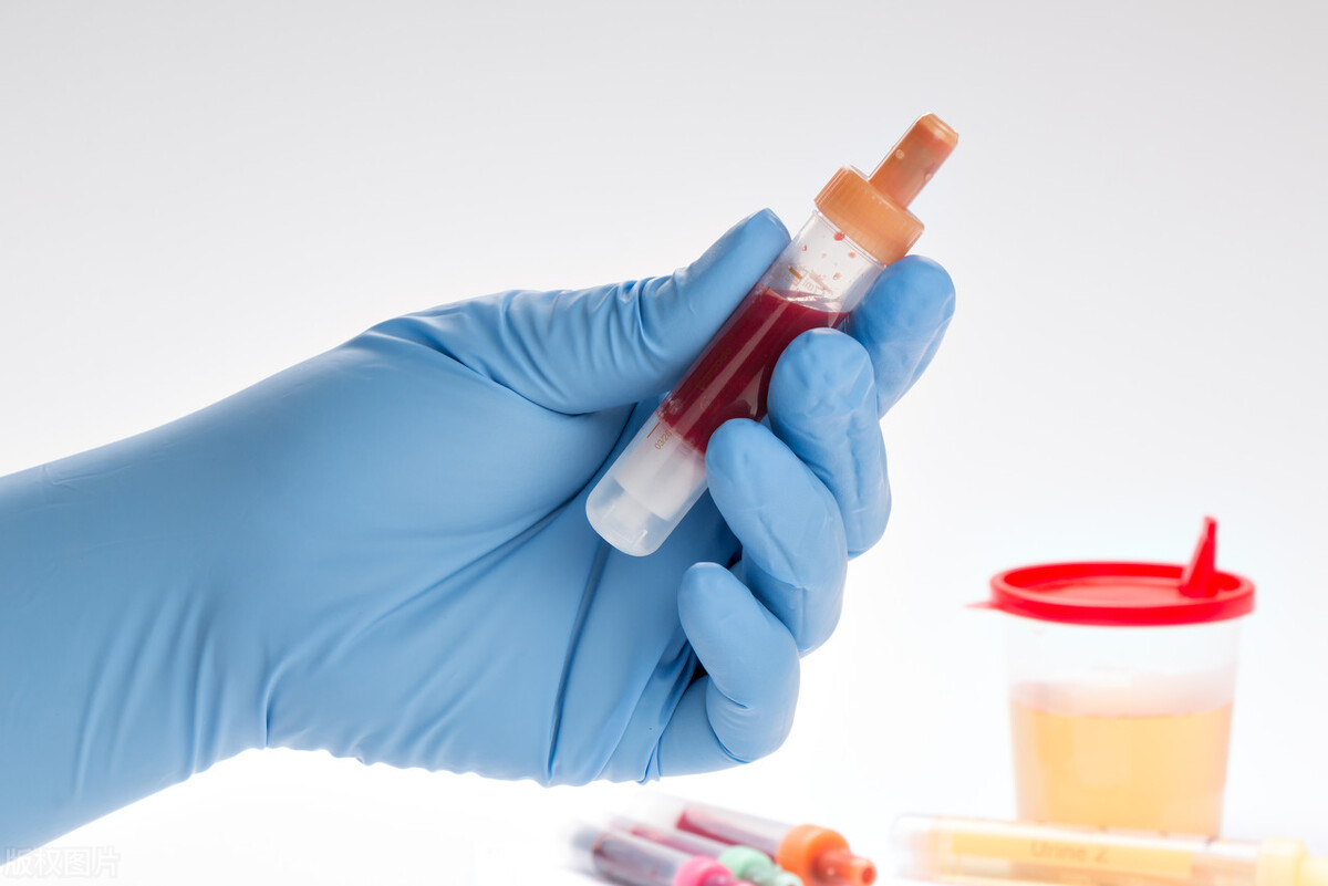 61岁阿姨血尿两月，竟是膀胱癌！预防的关键很多人都做不到