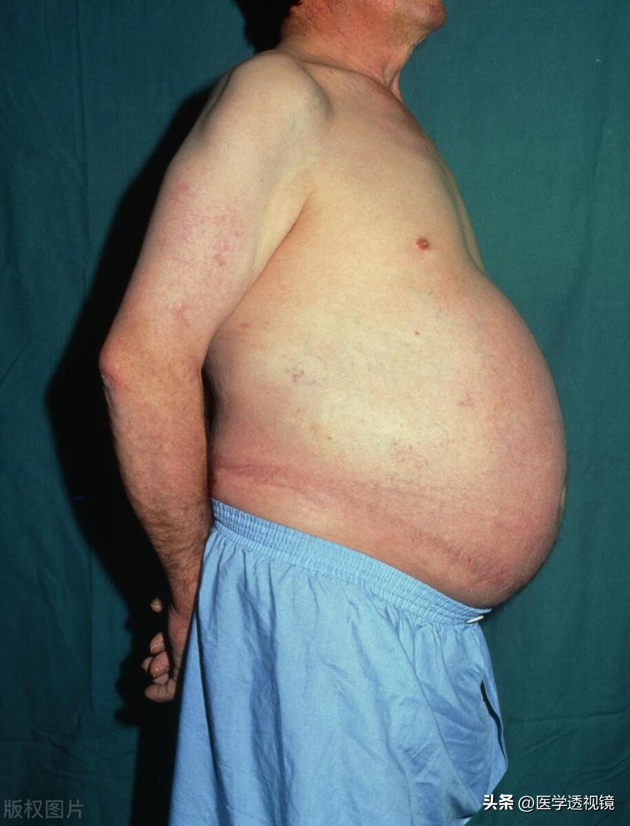 顽固性肝硬化腹水能活多久,肝硬化顽固性腹水能活多久