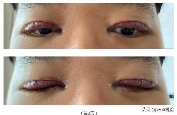 男生割双眼皮的意思,男生眼睛小割双眼皮会好看吗