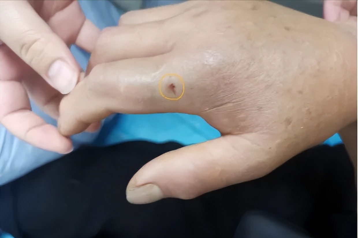 在农村被毒蛇咬了怎么处理,野外毒蛇咬伤怎样自救