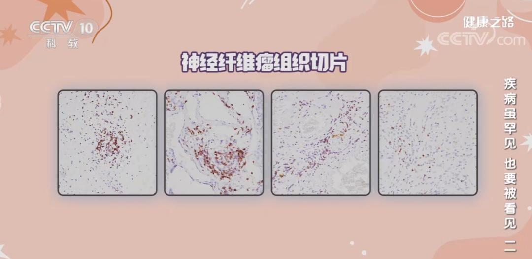 免疫疗法抗肿瘤视频,免疫疗法治愈肿瘤最新消息