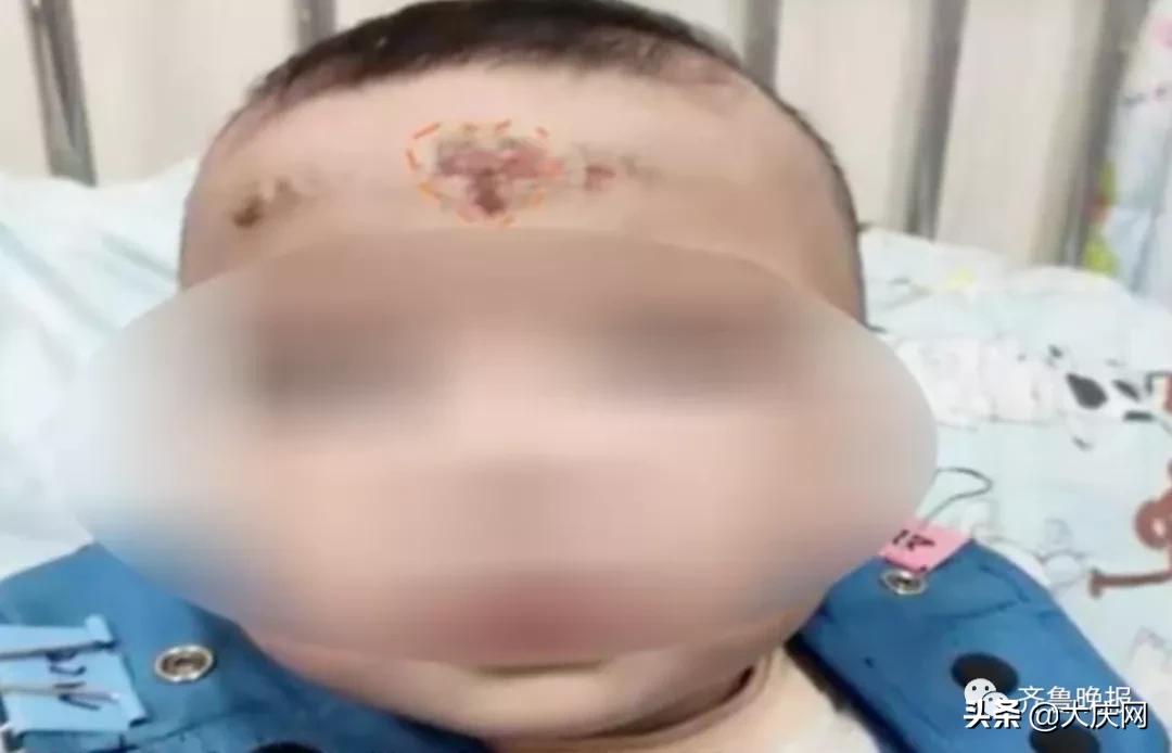 小孩高烧39度刮痧刮哪里,10个月婴儿反复高烧