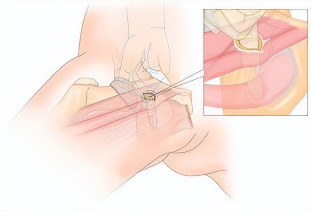 北京积水潭医院脊柱微创视频,北京积水潭医院矫形骨外科