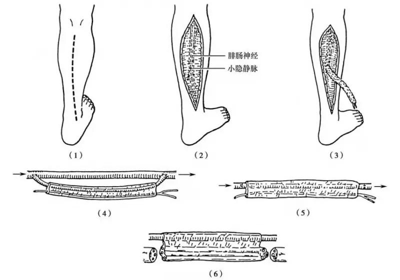 修复神经的最好方法,神经修复的最佳时间表