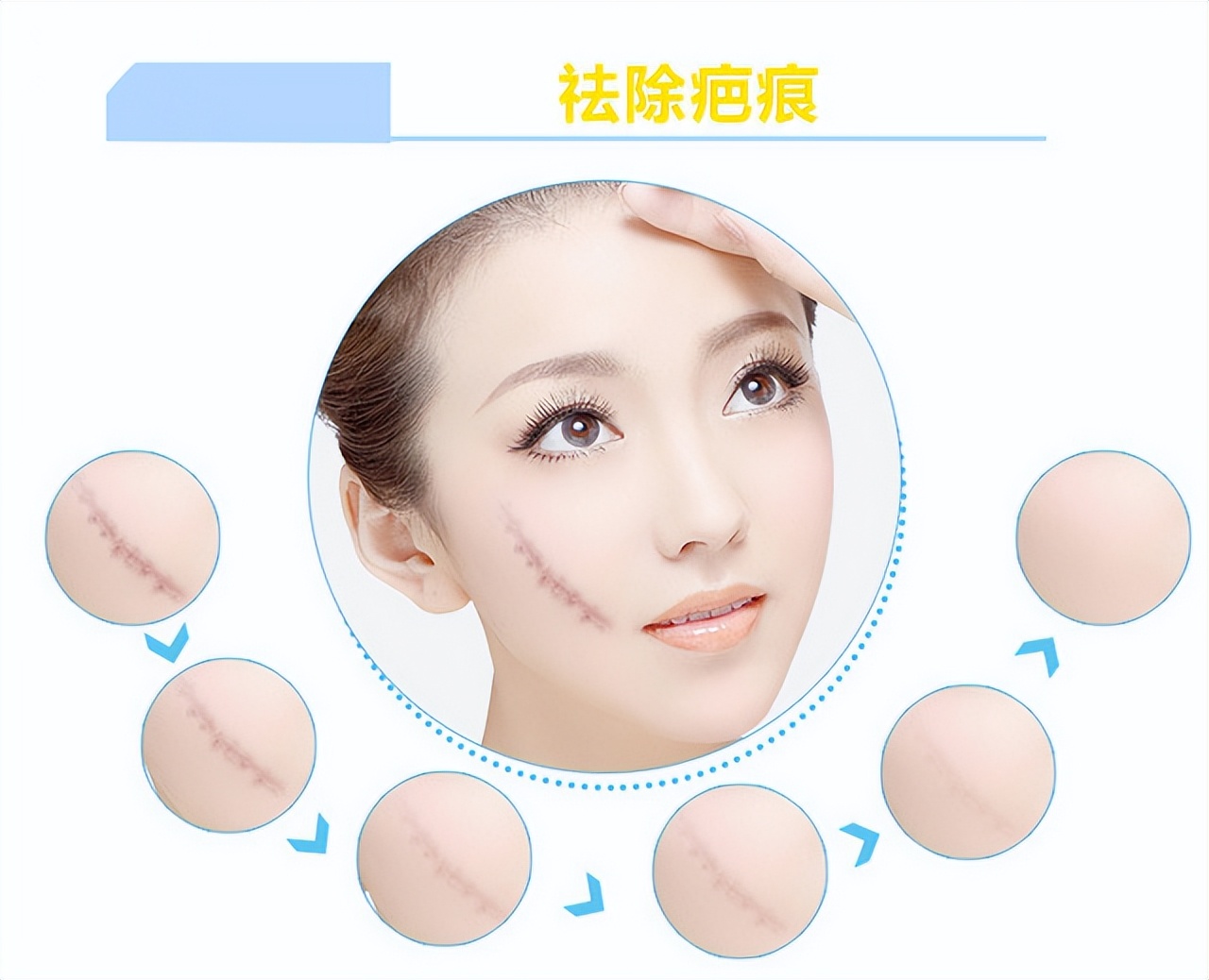 激光祛疤疤痕减轻的有效方式,激光如何祛疤痕