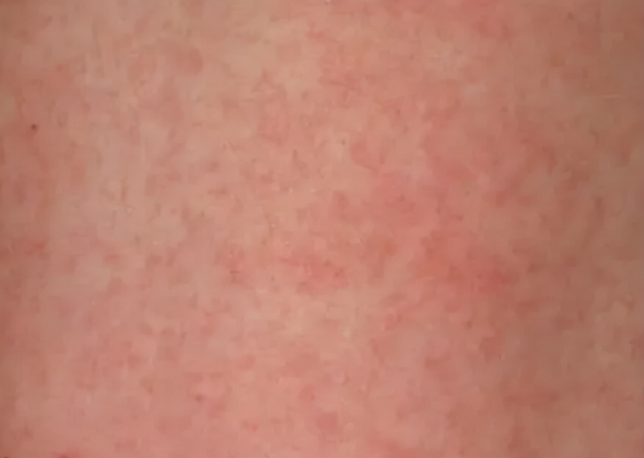 如果皮肤出现这些症状，及早做检查