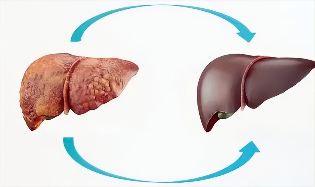 恭喜！陈先生，早期肝硬化成功“双转阴”！