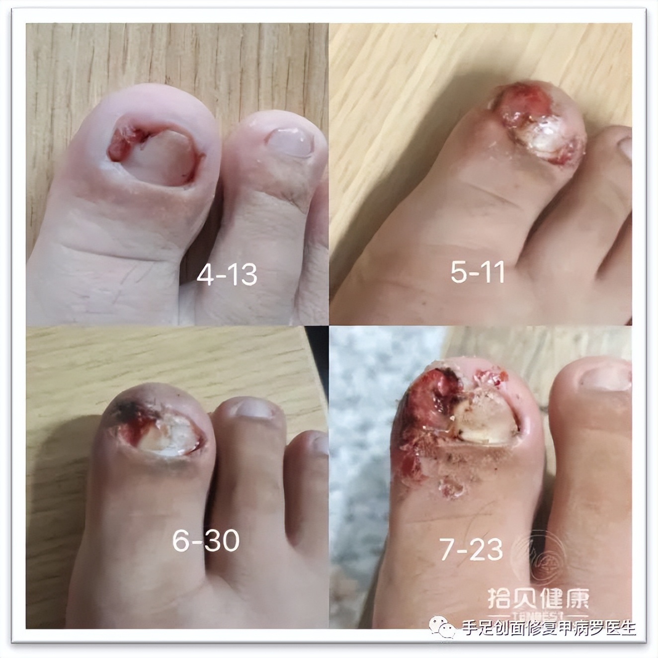 不要等孩子出了问题才重视,孩子得了甲沟炎怎么自己治疗