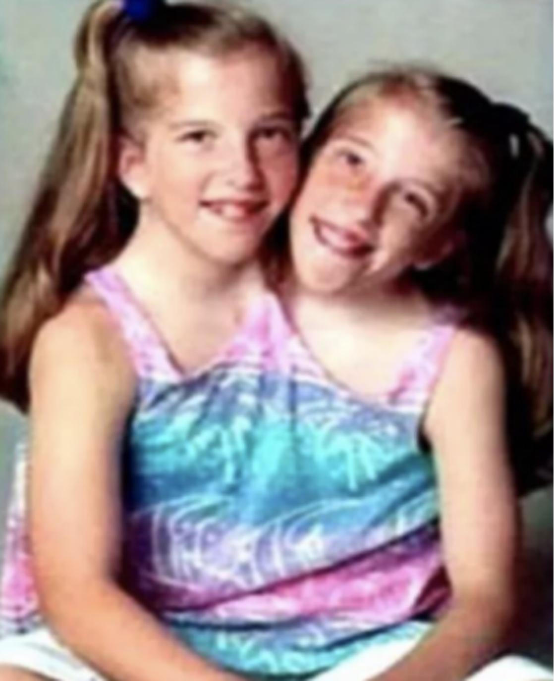 连体婴是不是有的共用一个大脑,两个大脑控制一个身体