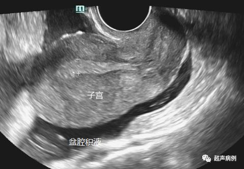 做阴道B超是一种什么样的体验?