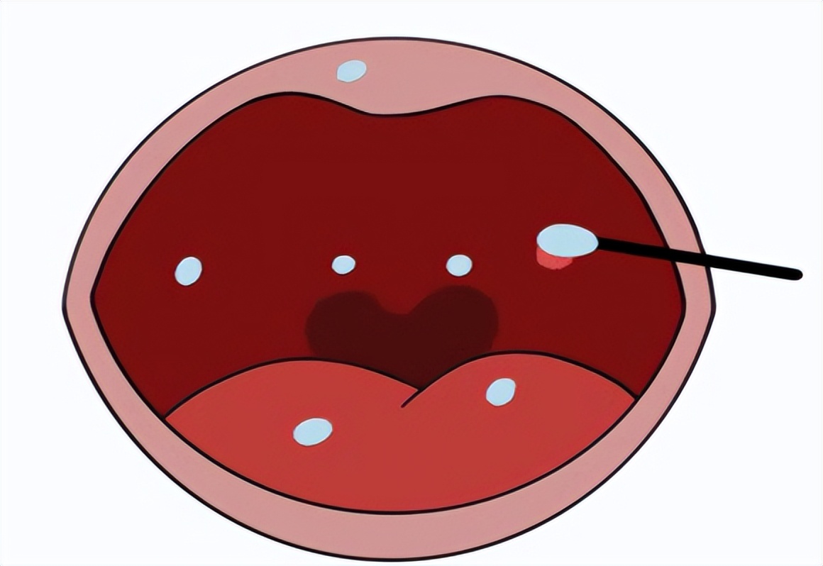 宝宝口腔有小白点是什么原因,五个月宝宝口腔上颚有白块图片