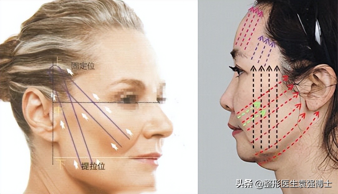 40岁后面部抗衰，填充、光电、线雕、拉皮哪个更靠谱？,医生总结