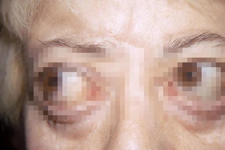 甲亢病是什么症状图片大全,甲亢病眼睛有什么症状