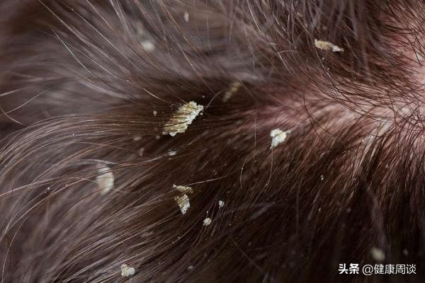 头皮发痒长疙瘩什么原因造成的,头皮发痒长疙瘩是什么原因引起的