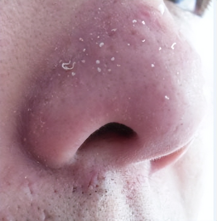 为什么鼻子可以挤出很大的黑头,用夹子挤出鼻子黑头