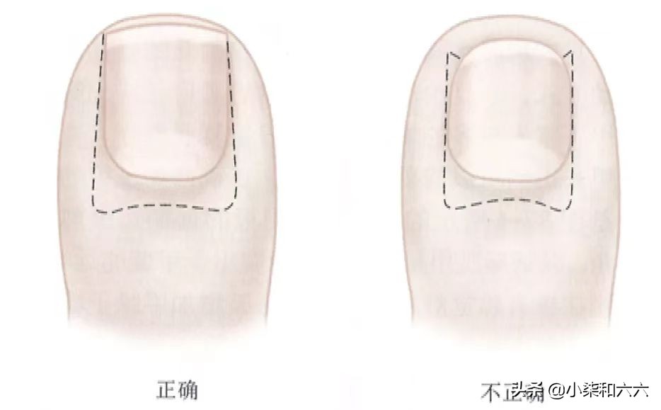 得了甲沟炎该怎么办？千万别急着拔甲