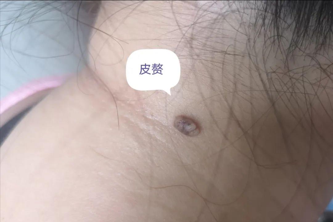 hpv病毒引起的疣是什么,hpv引起的病毒疣